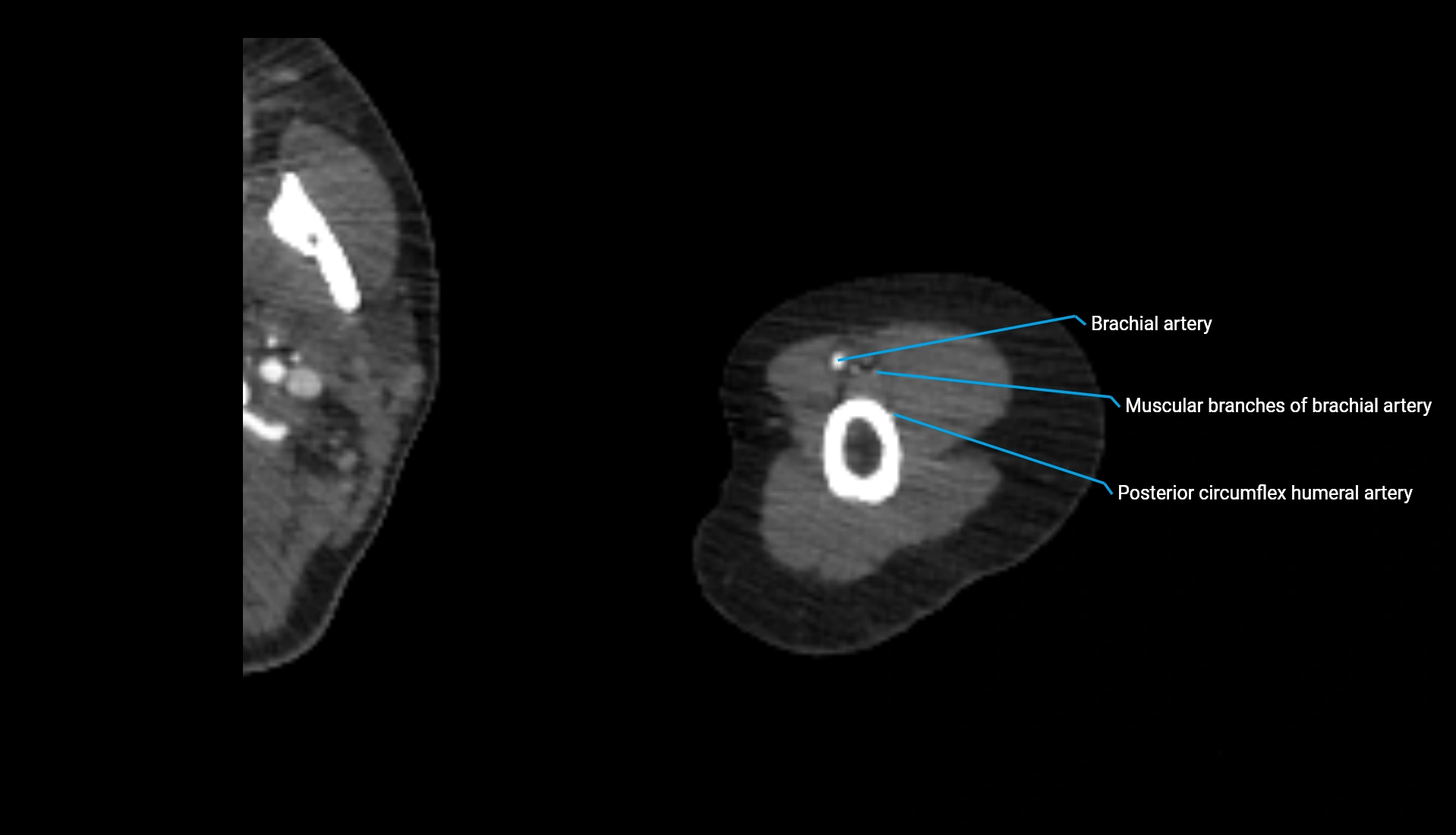 CTA upper limb axial cross sectional anatomy labelled image 283 (2).webp